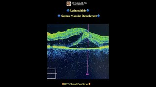 Retinoschisis Serous Macular Detachment [upl. by Sufur120]