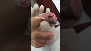 Desencravando Unhas com Granuloma 110121 [upl. by Ferna]