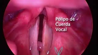 PÓLIPO DE CUERDAS VOCALES  VOCAL FOLD POLYP [upl. by Richlad]