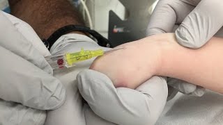 IV Insertion Technique in Infants and Small Children [upl. by Sarina799]