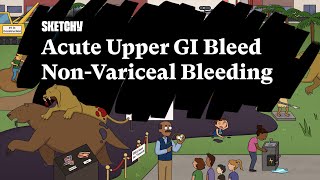 Acute Upper GI Bleed Lesson NonVariceal BleedingFull Lesson  Sketchy Medical  USMLE Step 2 CK [upl. by Odareg630]