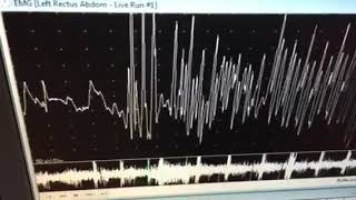 neuromyotonic discharges [upl. by Beatriz913]