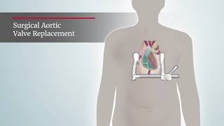 Aortic Stenosis Surgical Aortic Valve Replacement procedure [upl. by Nodgnal]