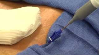 Got Intervertebral Disc Pain Get IntIntradiscal ElectroThermal Annuloplasty [upl. by Dagmar380]