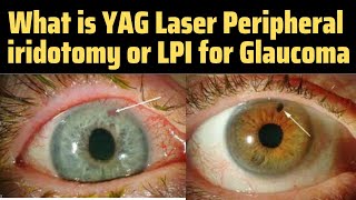 Peripheral Iridotomy  Lpi Eye Procedure  Yag Pi Laser  Lpi Eye Surgery  Glaucoma Treatment [upl. by Kerns365]