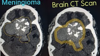 Brain tumor Meningioma [upl. by Zeba]