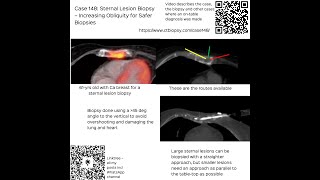 Case 148 Sternal Lesion Biopsy  Increasing Obliquity for Safer Biopsies [upl. by Bria]