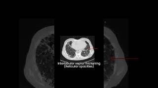 UIP Usual Interstitial pneumonia Idiopathic pulmonary fibrosis l Interstitial lung disease l HRCT [upl. by Risan550]