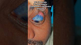 RE  Emmetropia LE  Scleromalacia  pseudophakia and Advance glaucoma [upl. by Irwinn521]