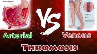 Arterial Thrombosis Vs Venous Thrombosis  Clear Comparison [upl. by Macleod479]