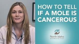 How to Tell if Your Mole is Cancerous  North Idaho Dermatology [upl. by Kuehnel]