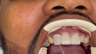 Houston Cosmetic DentistBeautiful Porcelain VeneersClose that gap and whiten my teeth [upl. by Yenduhc]