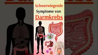 Schwerwiegende Symptome von Darmkrebs [upl. by Yennor]