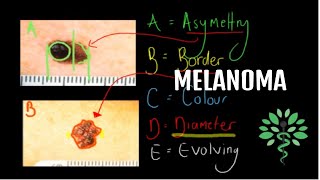 Melanoma  Symptoms signs diagnosis and management [upl. by Ainimreh]