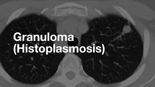 Classic Case Granuloma from Histoplasmosis [upl. by Derfnam]