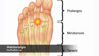 Metatarsalgia Foot Pain Causes Symptoms amp Treatments [upl. by Alvie]