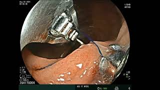 Endoscopic Bypass Revision For DumpingWeight Regain [upl. by Auqinahs110]