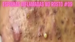 Espinhas Inflamadas no Rosto 09 [upl. by Ardnusal186]