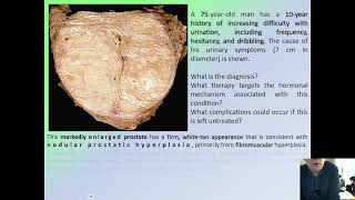 MALE GENITAL SYSTEM DISESES CASES [upl. by Solberg]