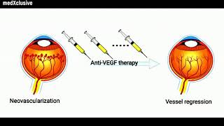 FDA Approves Ranibizumab Ocular Implant for AgeRelated Macular Degeneration AMD [upl. by Alemaj761]