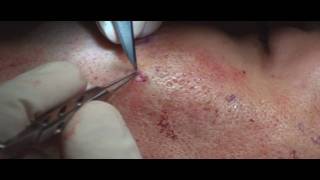 Acne Scar Revision Part 04 More Subcision Technique by Dr Young [upl. by Yblocaj]