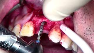 Step by Step Anterior Implant placement with GBR with voiceover [upl. by Naarah]