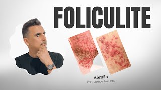 FOLICULITE O que é Quais pomadas indicadas Tratamento Medicamento [upl. by Misab]