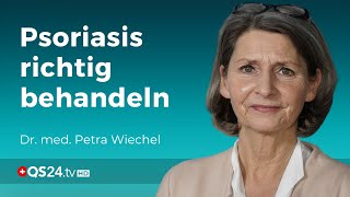 Schuppenflechte Auslöser und Behandlungsstrategien  Dr med Petra Wiechel  Visite  QS24 [upl. by Dovev]