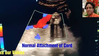 Marginal Cord Attachment to placenta How to See Tips in PregnancyUltrasound Velamentous cord [upl. by Halika]