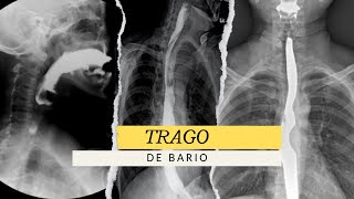 TRAGO DE BARIO ESÓFAGOGRAMA ESTUDIO RADIOLÓGICO radiologia anatomia radiology [upl. by Tiossem]