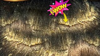 VDO127 Dry Itchy Scalp Removal  Removal Big Flakes [upl. by Idnahc]