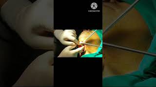 ગળાની રસોળી નું ઓપરેશન गले में गठानthyroglossal cyst removal under local anaesthesiatruptient [upl. by Eilahs]