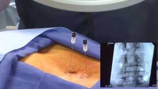 WATCH an Epidural Steroid Injection Demonstration  LIVE [upl. by Starling]