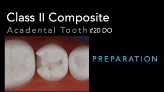 Class II Composite Preparation  Acadental Tooth 20 DO [upl. by Ardnayek158]