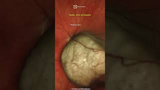 Choroidal Melanoma [upl. by Kcirdet]