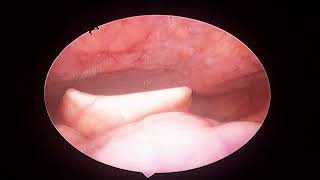 GERD and Granular Pharyngitis [upl. by Ynoep]