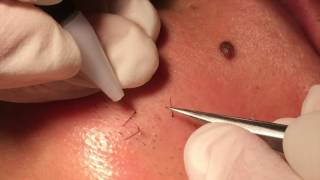 Electrolysis hair removal close up [upl. by Fakieh]