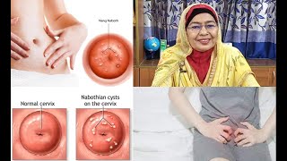 Nabothian cyst l নেবোথিয়ান সিস্ট [upl. by Ohare]