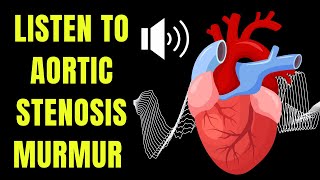 Doctor explains AORTIC STENOSIS including real heart SOUNDS of the murmur [upl. by Tobias]