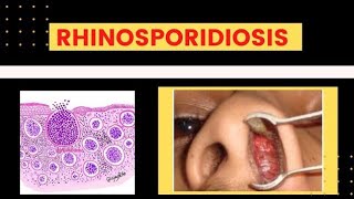 Rhinosporidiosis Subcutaneous Mycosis [upl. by Enavi]