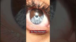 Girl Has Rare Eye Called Heterochromia [upl. by Auqinat]