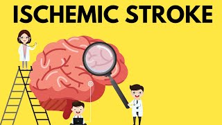 The Essential Guide to Ischemic Stroke [upl. by Yanetruoc266]