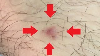 Ingrown Hair Removal on Mans Leg [upl. by Einohpets498]