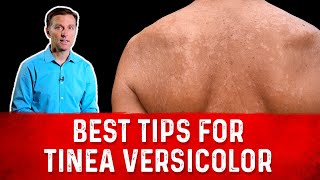 Best Tips for Tinea Versicolor Treatment Skin Fungus – Dr Berg [upl. by Anawot991]