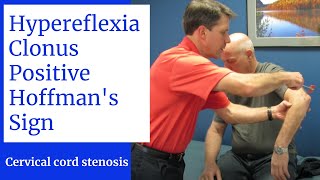 Hyperreflexia Clonus Positive Hoffmans Sign Central Cervical Spine Stenosis [upl. by Aicilaanna]