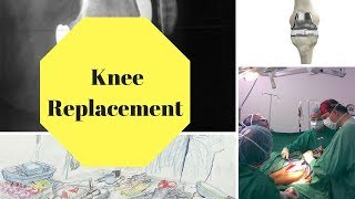 Arthrofibrosis After Knee Replacement [upl. by Citarella189]