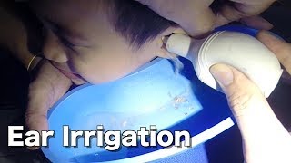 5 Year Old Boys Earwax Removal by Ear Irrigation [upl. by Siahc]