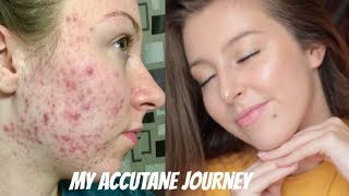 MY ISOTRETINOIN ACCUTANE JOURNEY  BEFORE AND AFTER PHOTOS [upl. by Notyap]