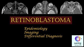 RETINOBLASTOMA Case discussion Epidemiology Imaging and Differential Diagnosis [upl. by Sky]