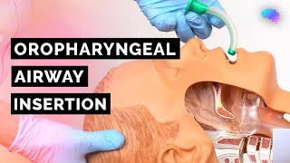 Oropharyngeal Airway Insertion  Guedel  OPA  ABCDE Emergency  OSCE Guide  UKMLA  CPSA [upl. by Oyr]